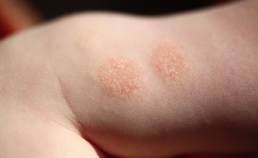 dermatitis atopik anak