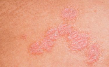psoriasis skin