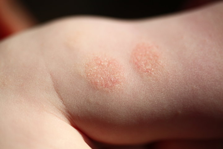 dermatitis atopik anak