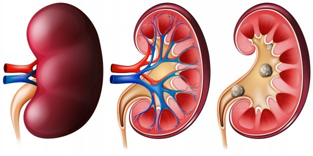 Cysts In The Kidneys Symptoms Premier Jatinegara Hospital