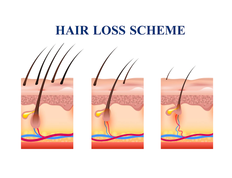 Mengenal Alopecia Kebotakan Premier Jatinegara Hospital