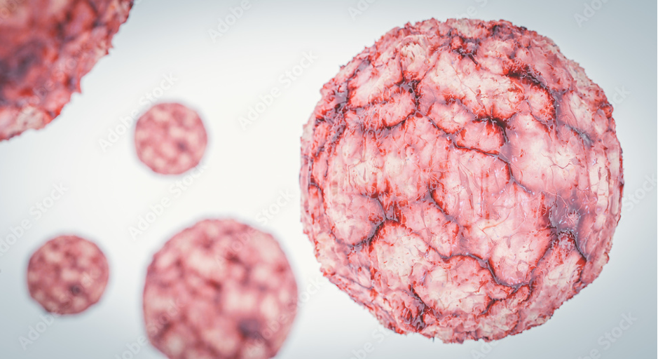 Perbedaan Kista Tumor Dan Kanker Premier Jatinegara Hospital
